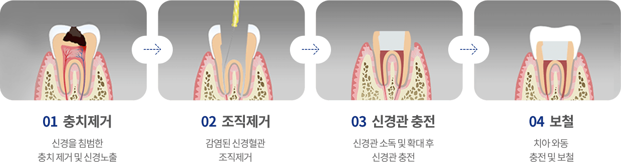 신경치료 과정
