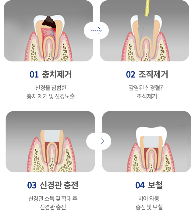 신경치료 과정