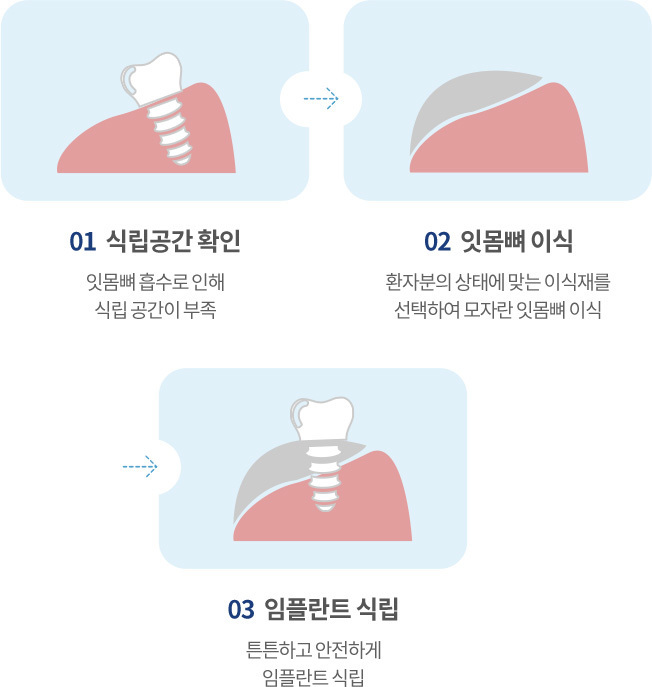 시술과정