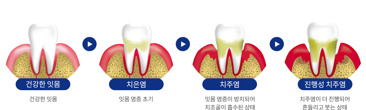 치주질환 진행 단계