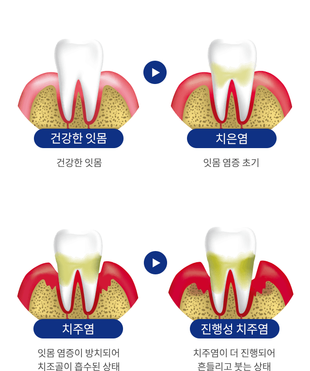 치주질환 진행 단계