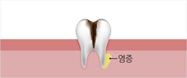 04. 이 뿌리까지 썩은</br>상태 [치수괴사]